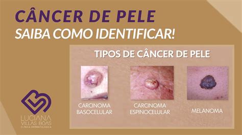 câncer de pele-1